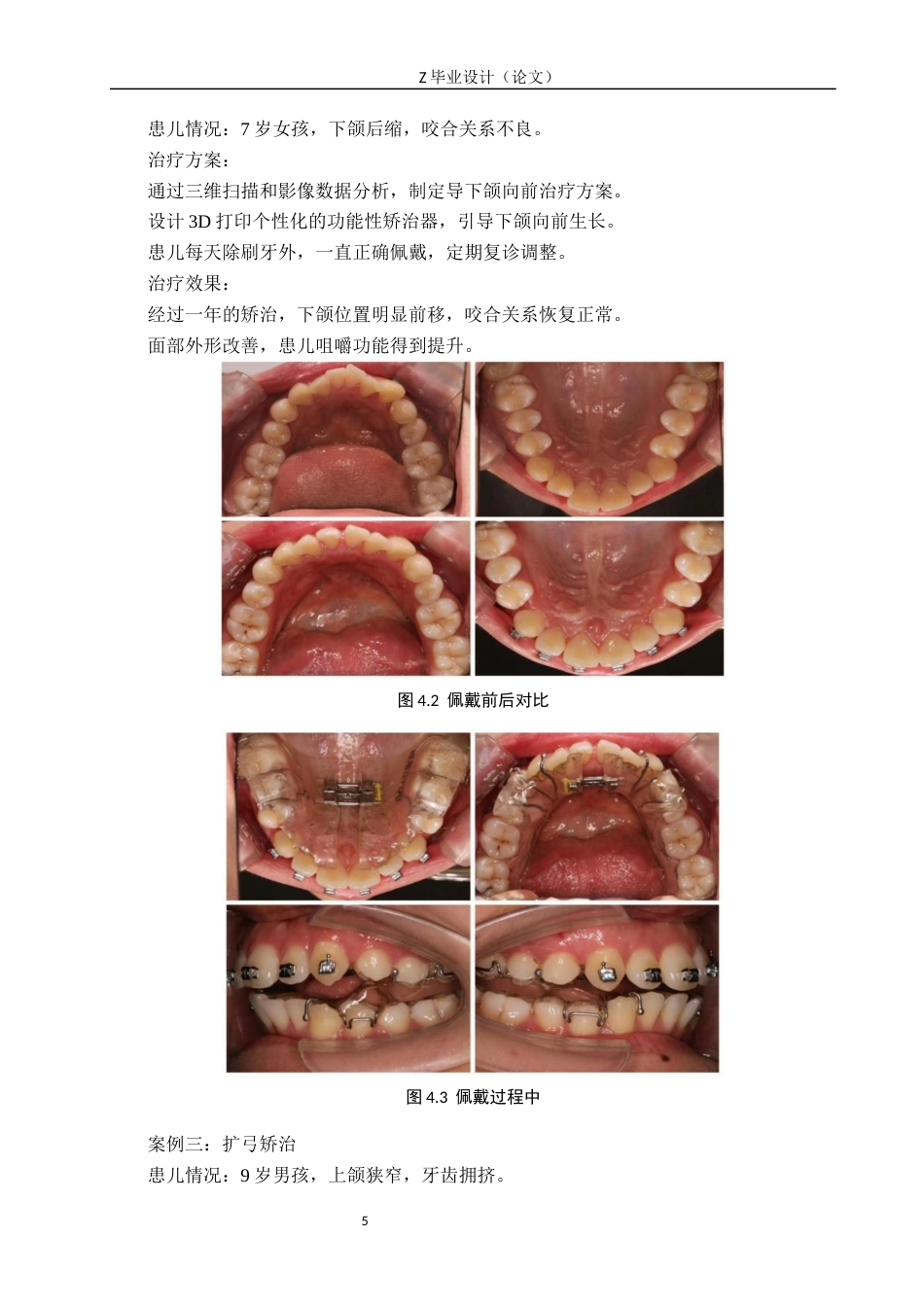25年WP口腔医学技术-3D打印在儿童早期干预中的应用与发展-查重15.96AI62.270-9212.docx_第8页